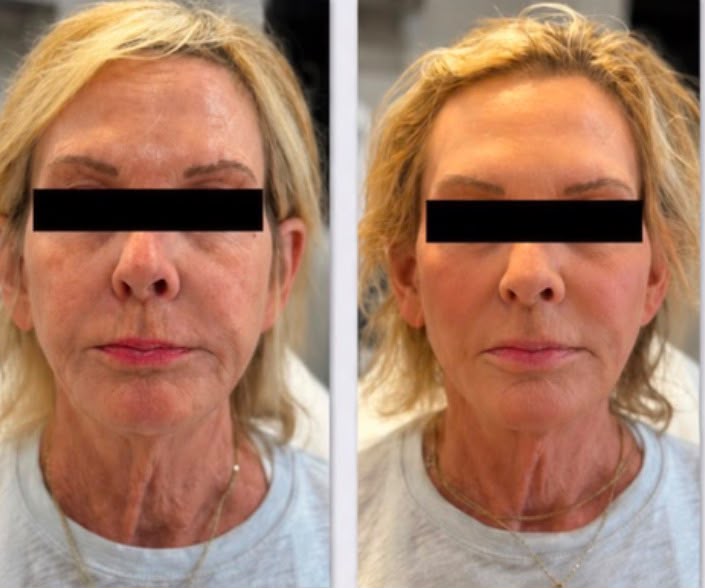 Resultado GHK-Cu - Antes e Depois