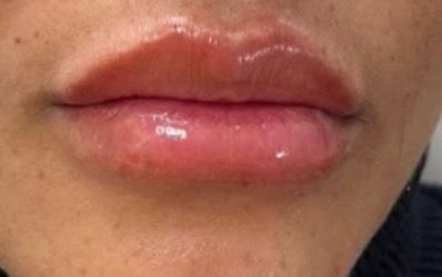 Resultado antes e depois