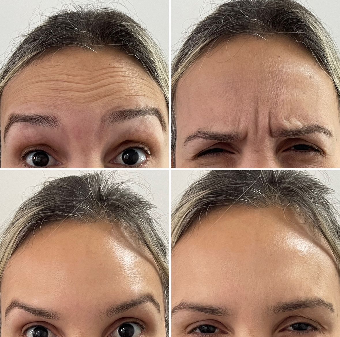 Resultado antes e depois